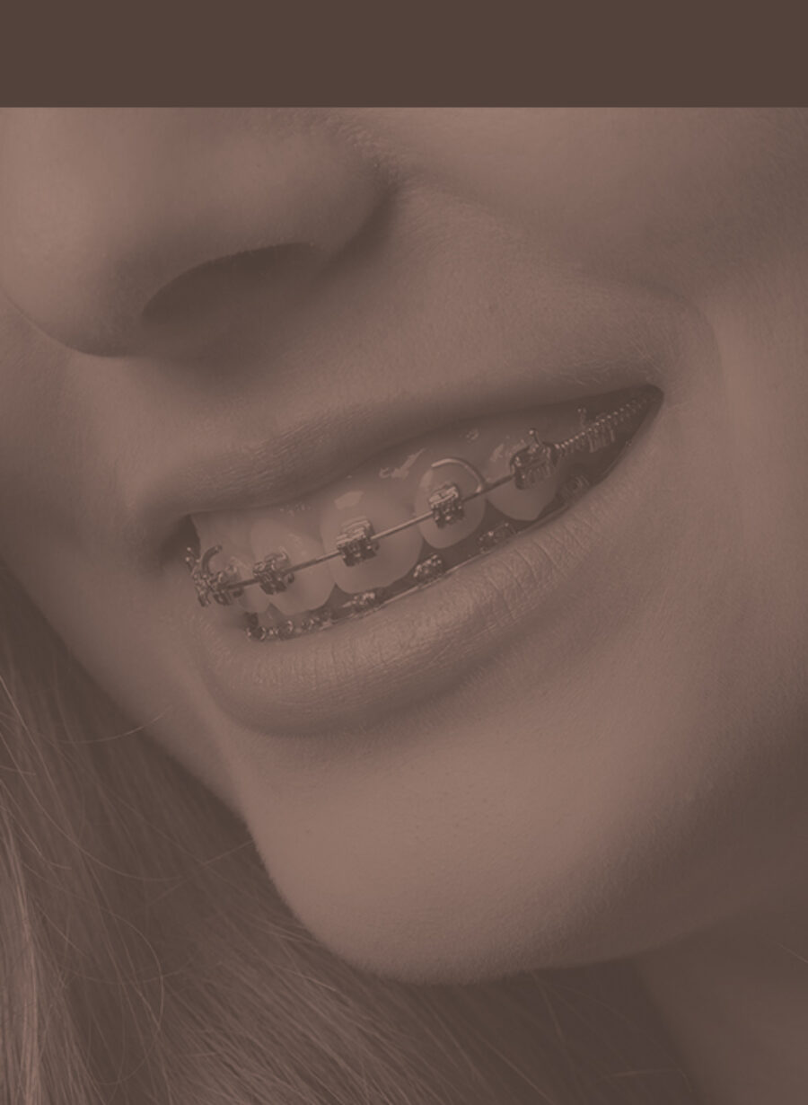thumb1-fixed-metal-braces Treatment Image
