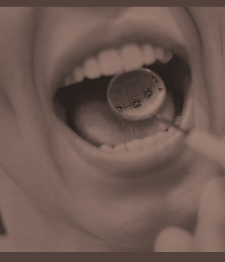 thumb2-fully-customised-lingual-braces Treatment Image 1