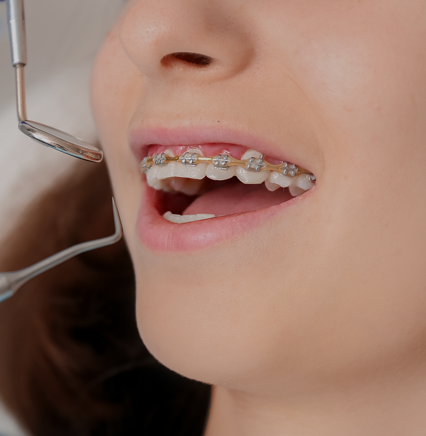 conventional braces Treatment - Dr Erfan Salloum