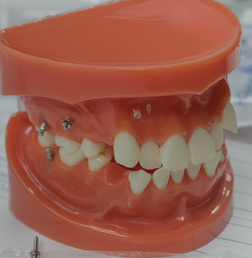 miniimplant Treatment - Dr Erfan Salloum