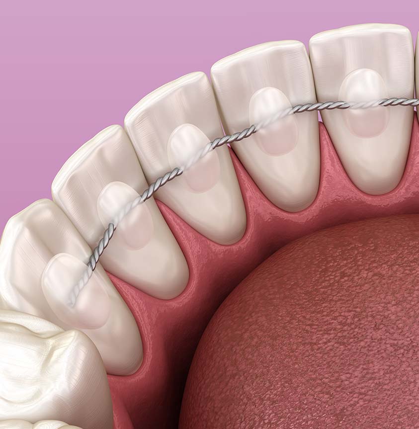 retainer.1 Treatment - Dr Erfan Salloum